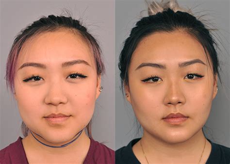 buccal fat removal surgery.